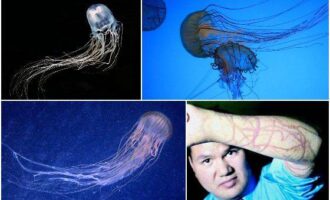 Как лечить укус медузы